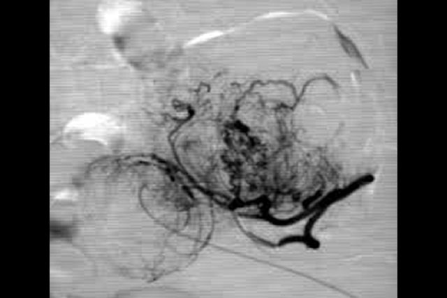 Treatment of Uterine Myomas