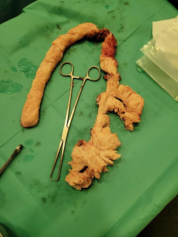 Uterine myoma 14 cm in size
