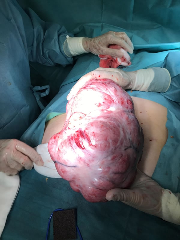 Myomas removed by laparotomy