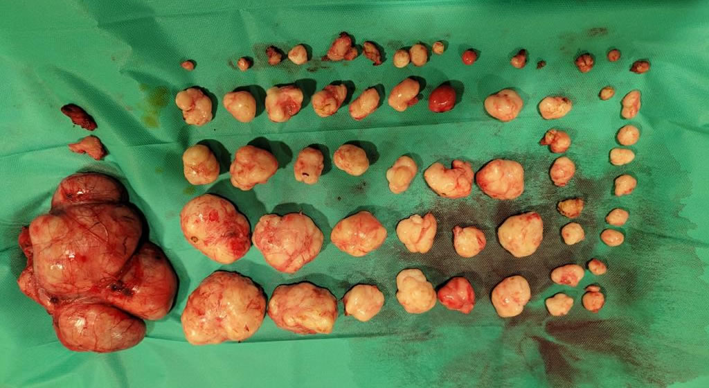 Extraction of 61 uterine myoma