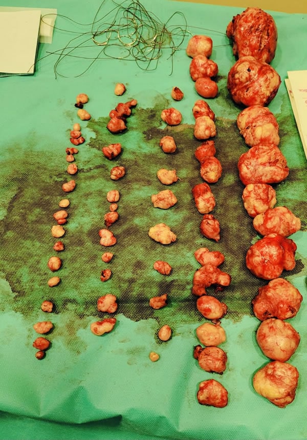 Removal of 74 uterine myomas without blood transfusion