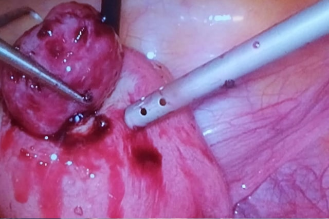 Laparoscopic Myoma Removal